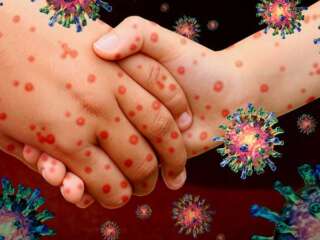 ADVIERTEN REBROTES DE SARAMPIÓN EN AMÉRICA